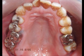 Orthodontic library ID. Dental crowding  Chart