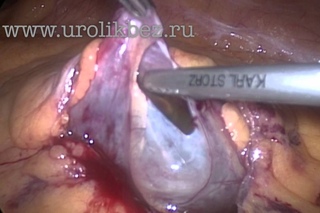 Лапароскопическая декортикация кисты левои почки laparoscopic kidney cyst  resection