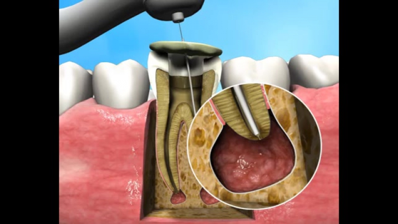 Treatment of Apical Periodontitis a new