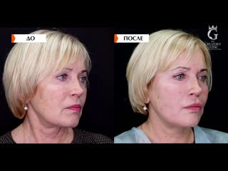 Армирование нитями RESORBLIFT на основе полимолочной кислоты