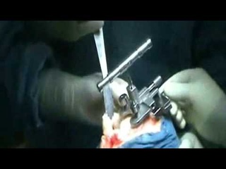 Операцию по эндопротезированию коленного сустава выполняет доктор медицины Евгений Кляйн
